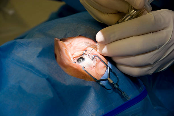 Retina Surgery