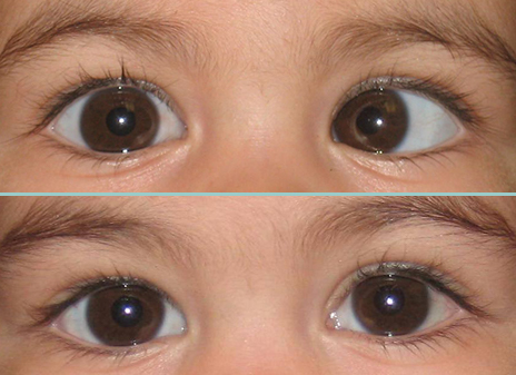 Squint Surgery