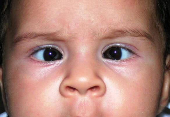Causes of Squint