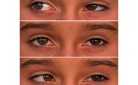 Preventing Squint
