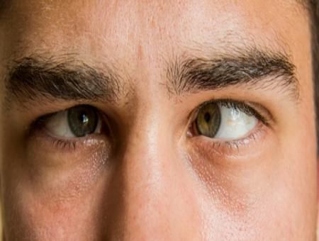 Risks of Squint Surgery