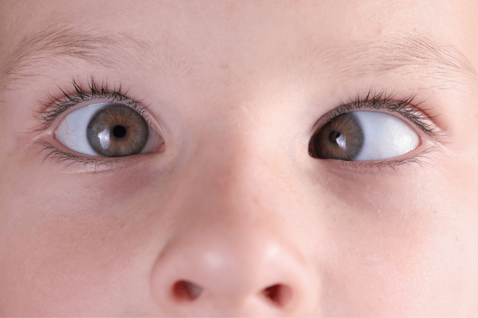 Symptoms of Squint
