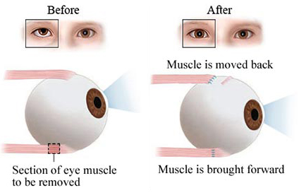 Squint Treatment Options